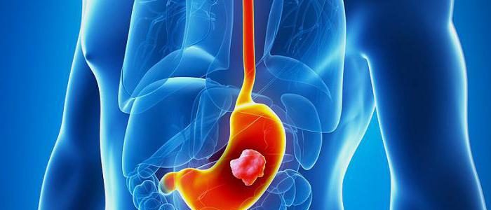 Перстневидноклеточный рак желудка: симптомы и лечение, прогноз