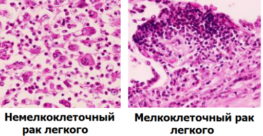 Мелкоклеточный рак. Мелкоклеточная нейроэндокринная карцинома гистология. Немелкоклеточная карцинома легкого. Мелко клеточный прак легких. Немелкоклеточный РПК легких.